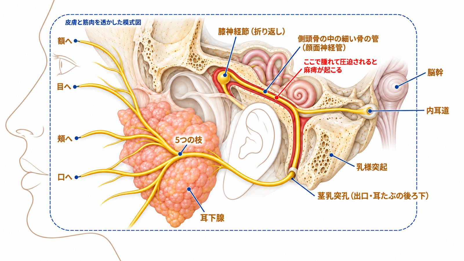 脳幹から耳の後ろの骨の管を通って顔の筋肉へ届く顔面神経の通り道と、腫れて圧迫される場所の図解