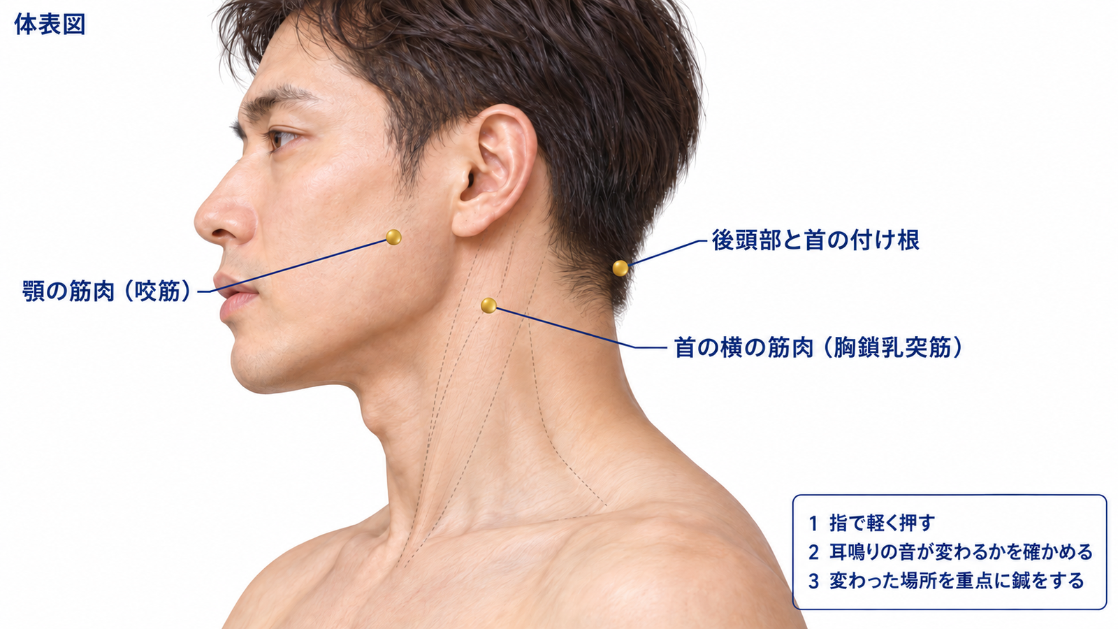 首の横の筋肉、後頭部、顎の筋肉を押して耳鳴りの変化を確かめる反応点の体表図