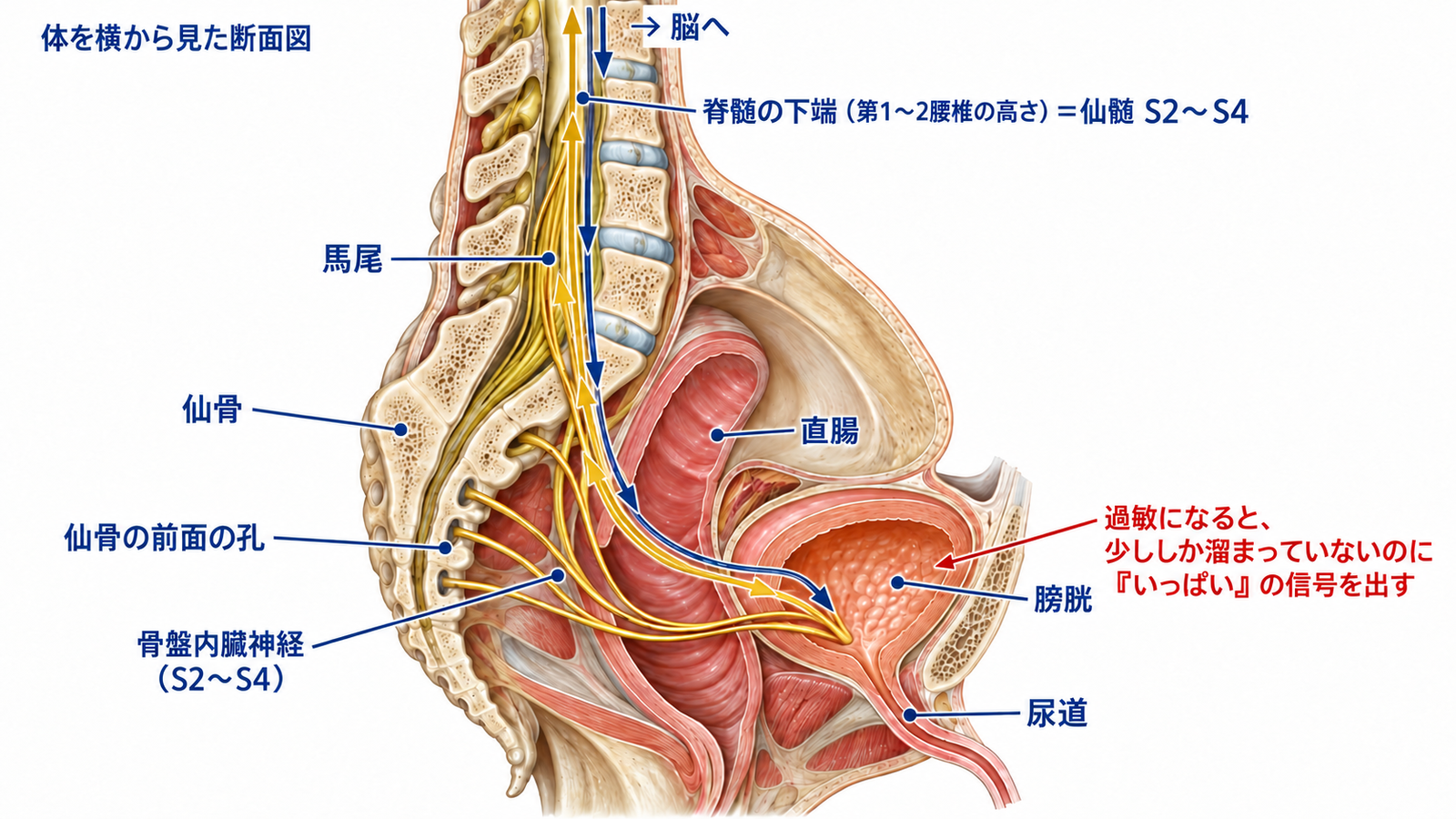 膀胱の感覚が脊髄を通って脳とやり取りする仕組みと、少ししか溜まっていないのに「いっぱい」の信号を出す過敏な膀胱の図解