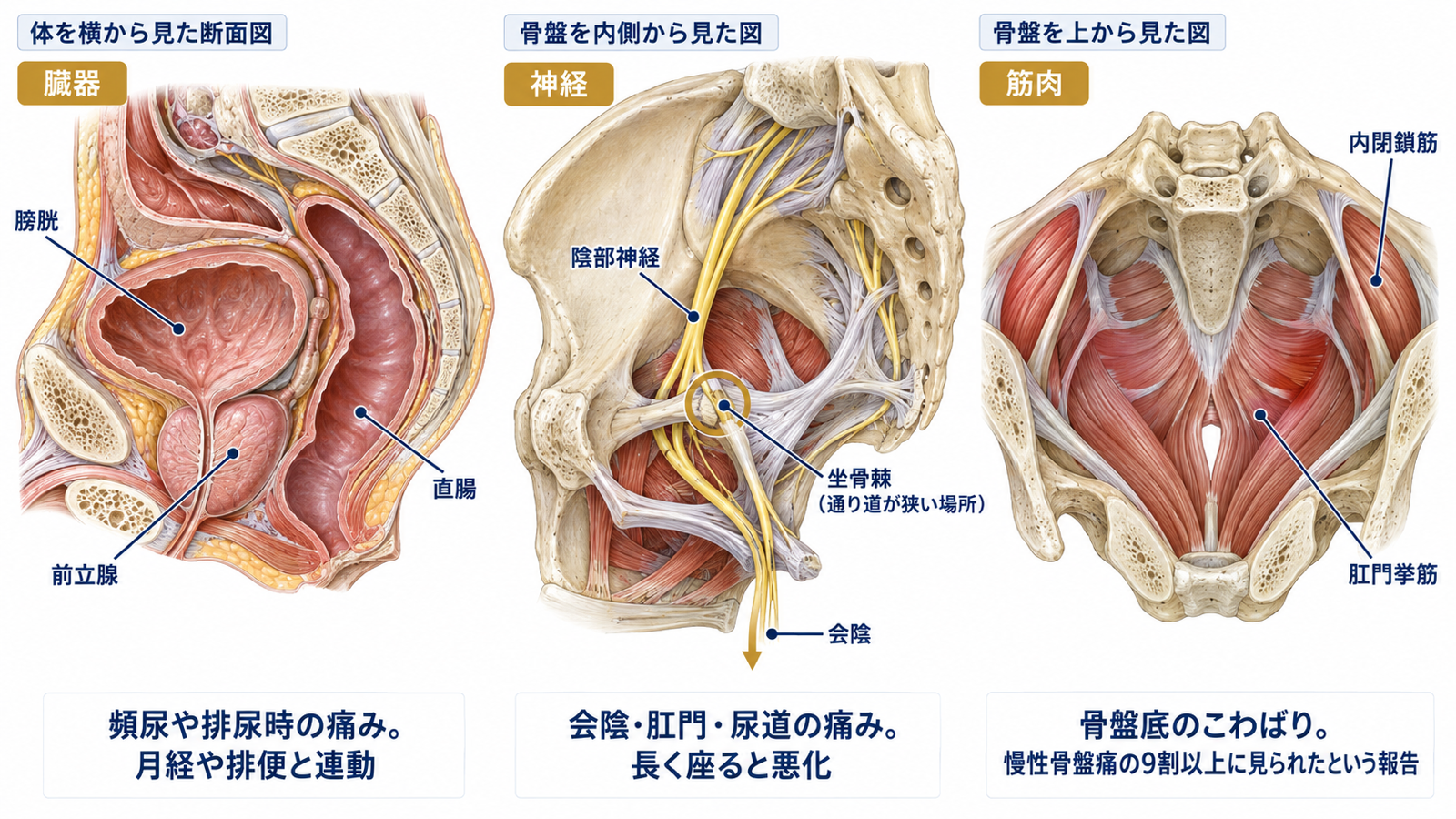 慢性骨盤痛の痛みの主座を臓器・神経・筋肉の3つに分け、それぞれの特徴と鍼をする部位を示す図解